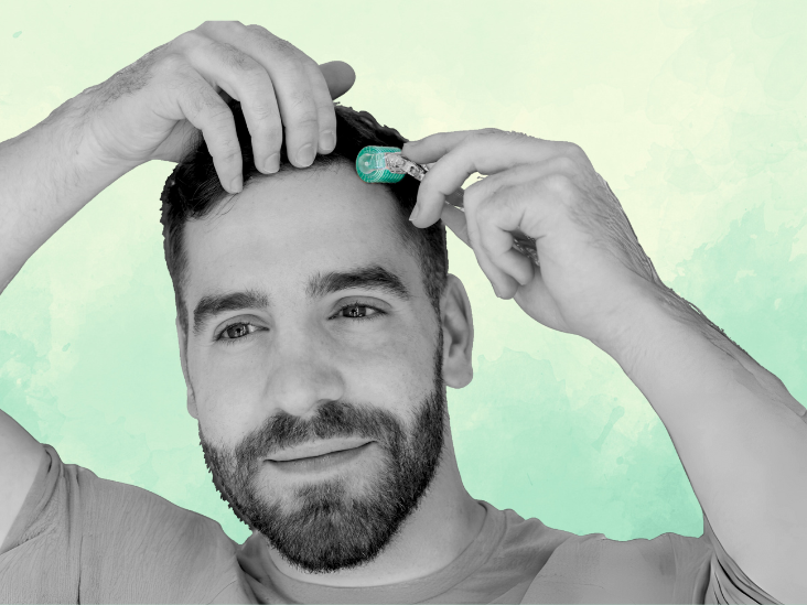Does the derma roller work against hair loss? – Follicly