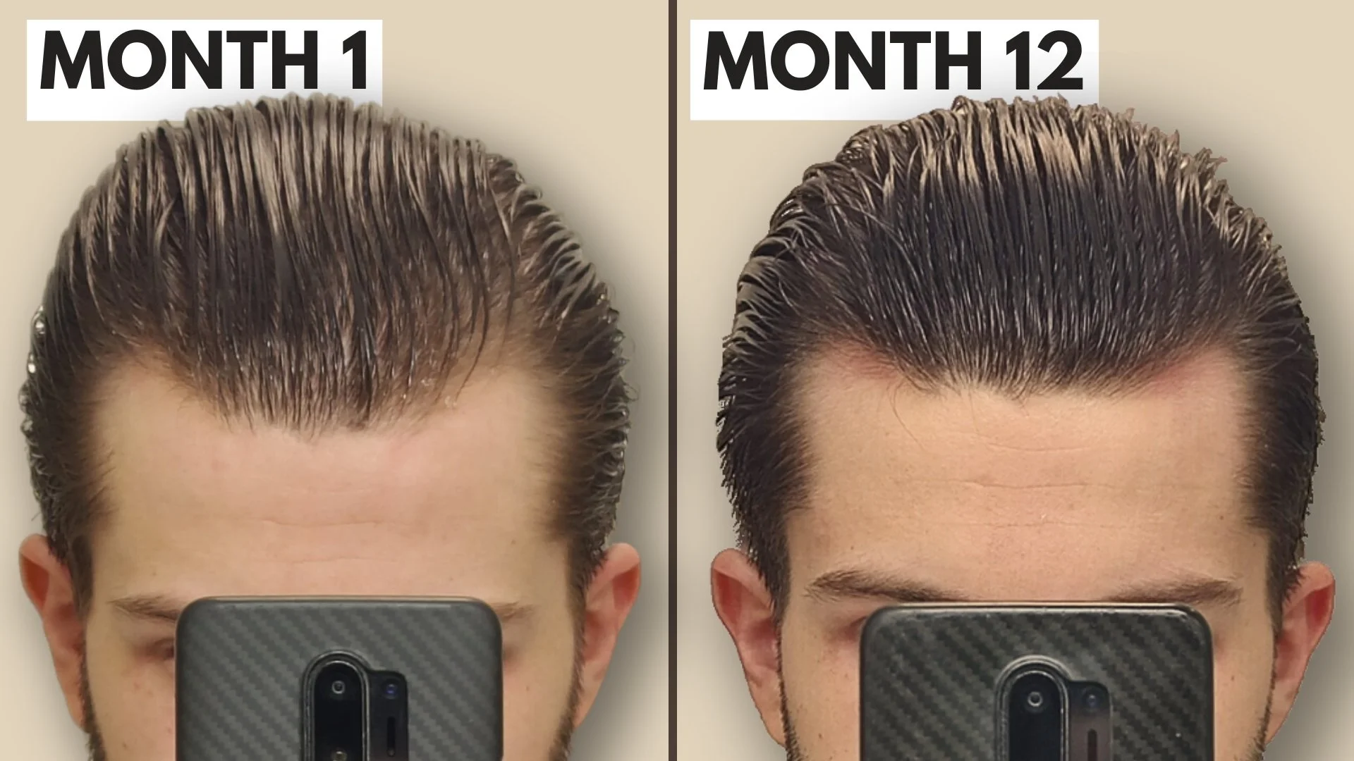 The Best Derma Roller for Hair Loss – Follicly