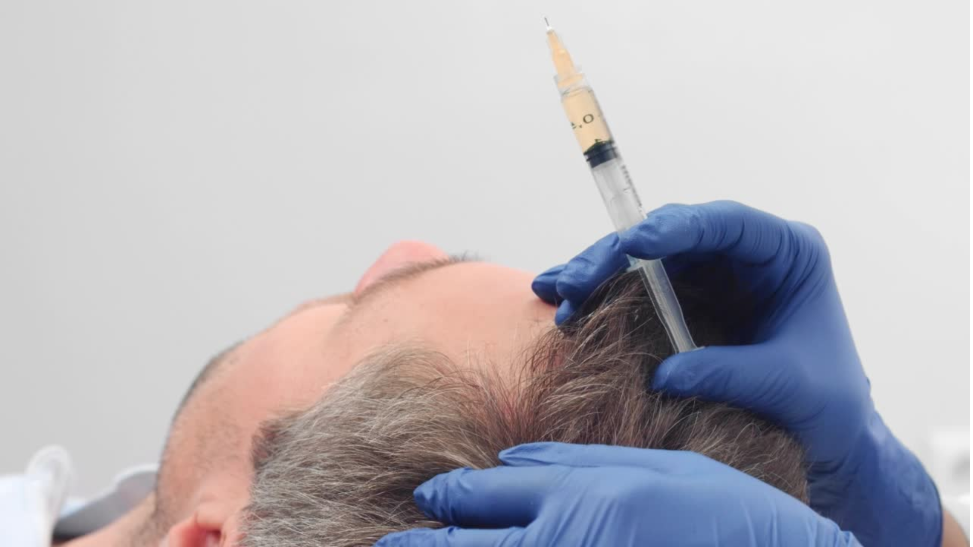 PRP (Platelet-Rich Plasma) and Injectables for hair loss.