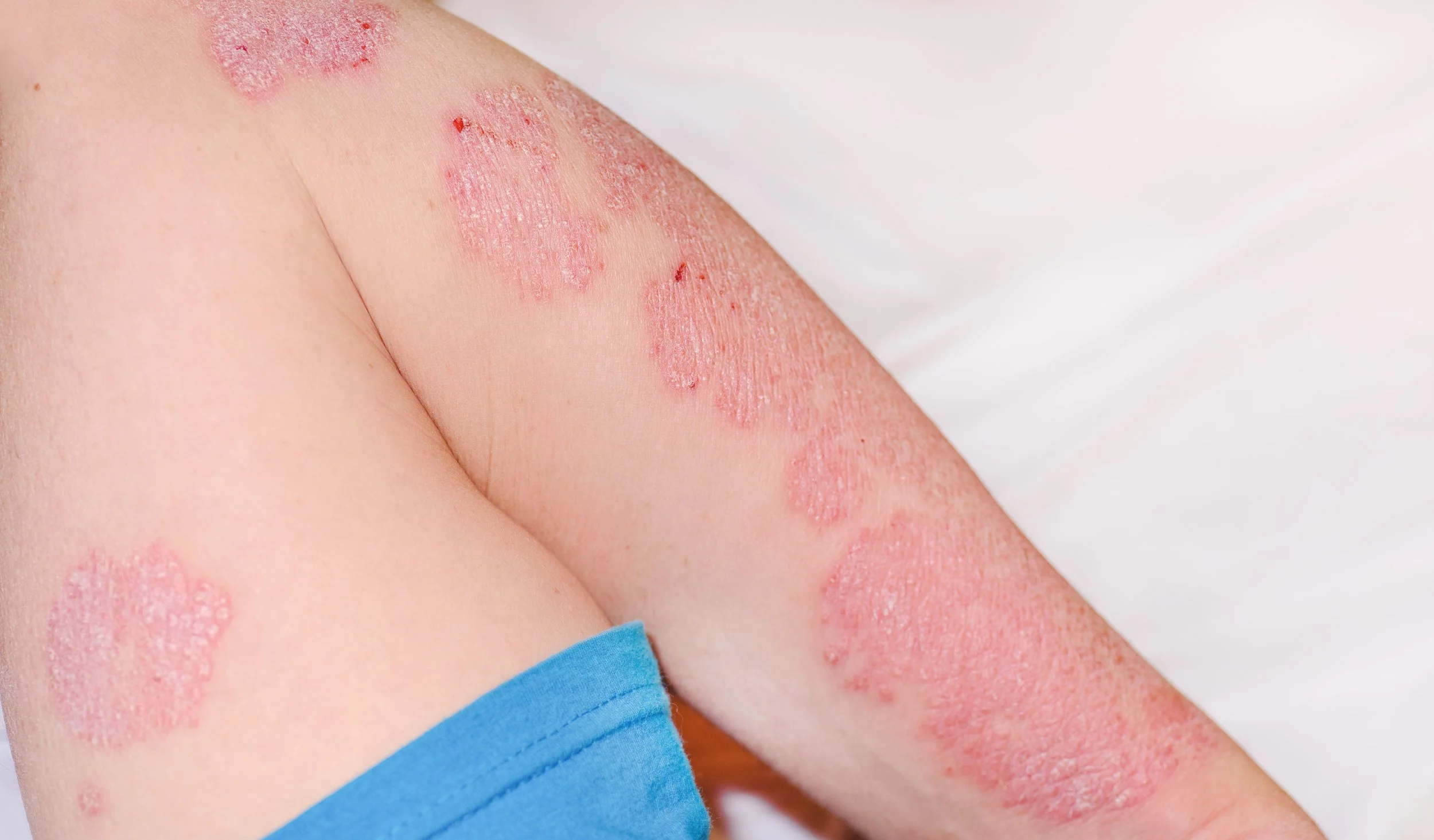 Psoriasis and Emerging Research Around Cannabinoids
