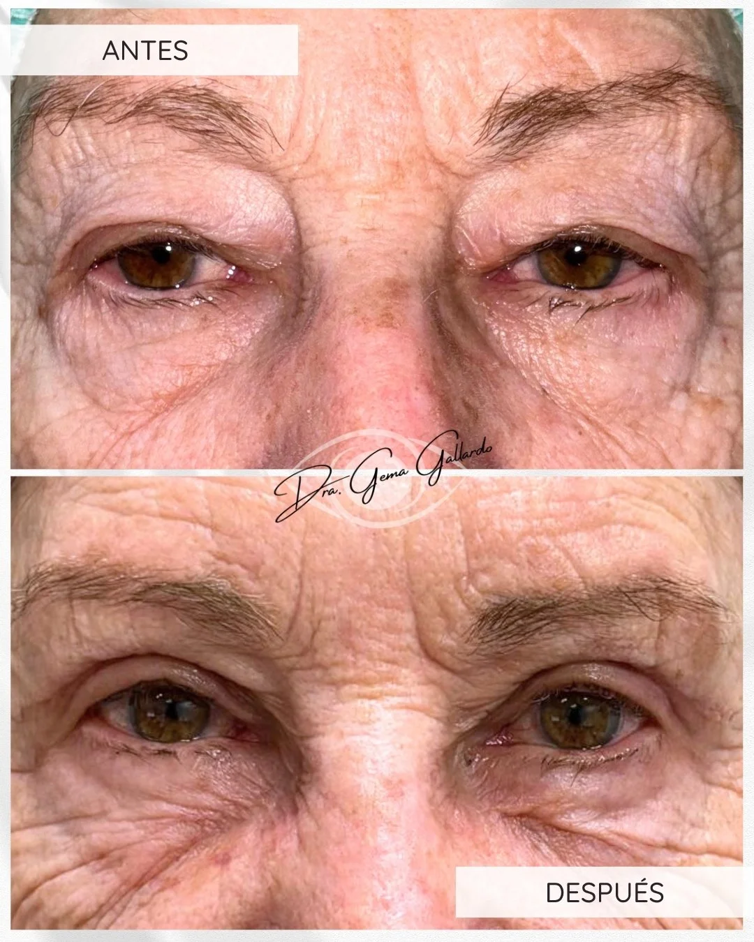 Ptosis y blefaroplastia (técnica conjuntivomüllerectomía).jpg