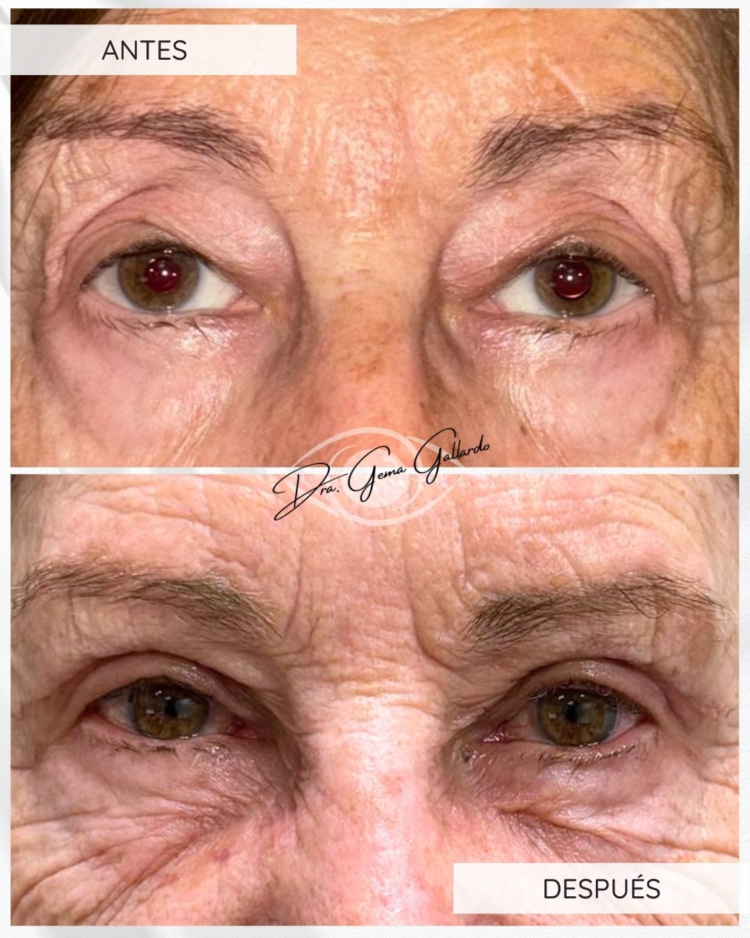 Ptosis y blefaroplastia (técnica conjuntivomüllerectomía) (2).jpg