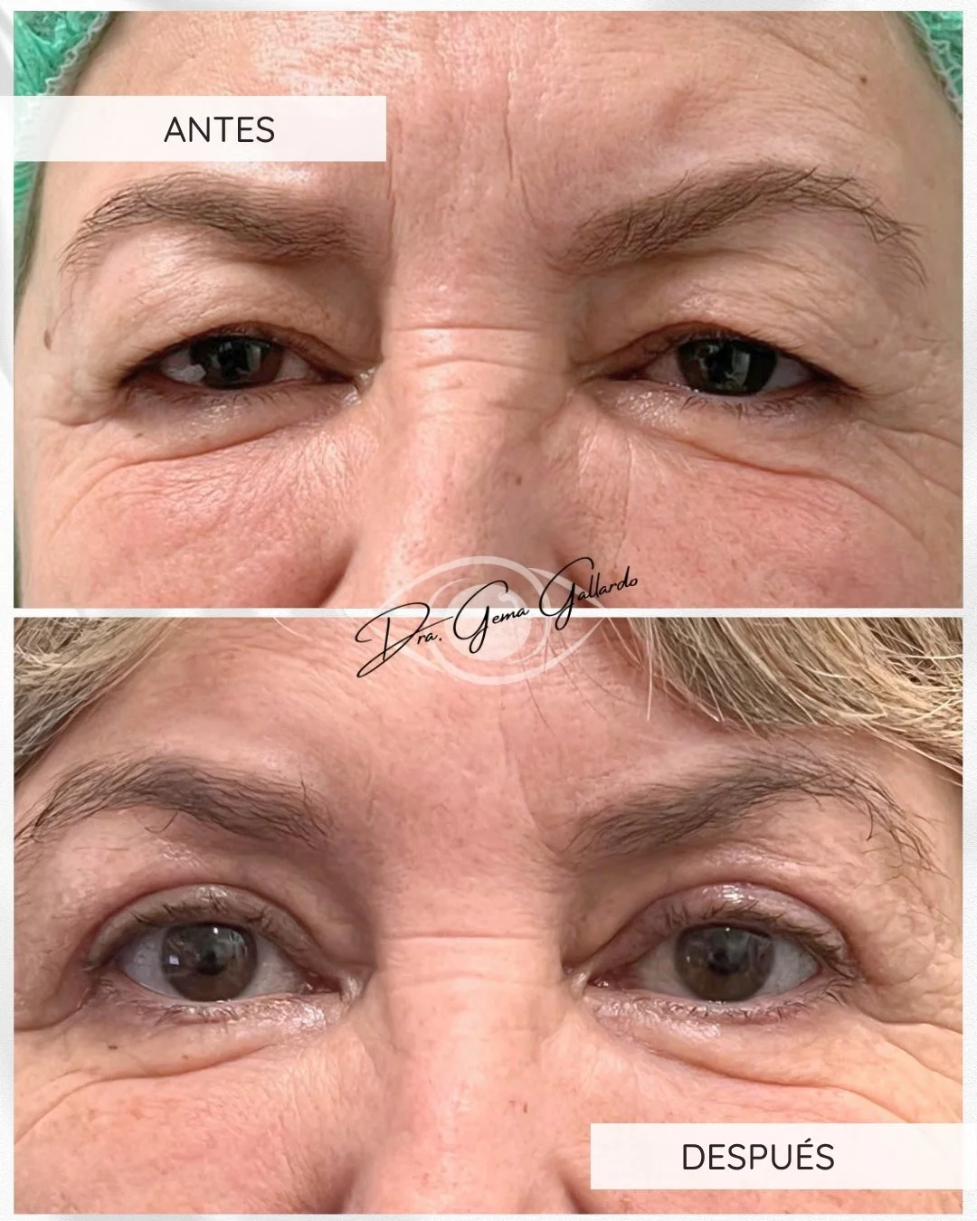 Blefaro superior con conjuntivomüllerectomía (2).jpg