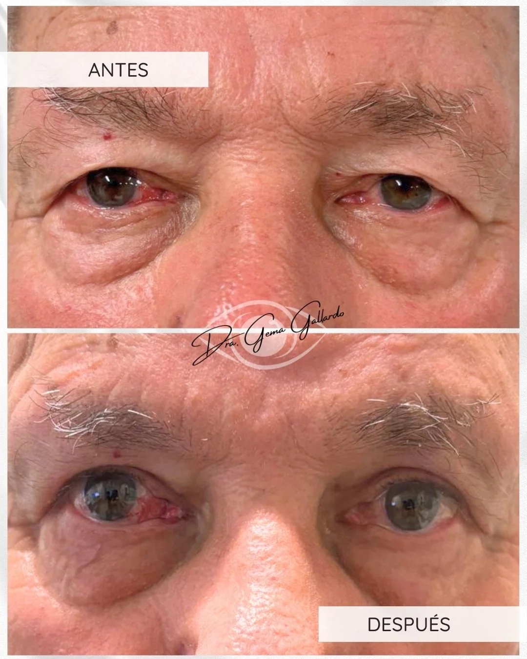 Blefaro con reposición de glándula lagrimal bilateral (3).jpg