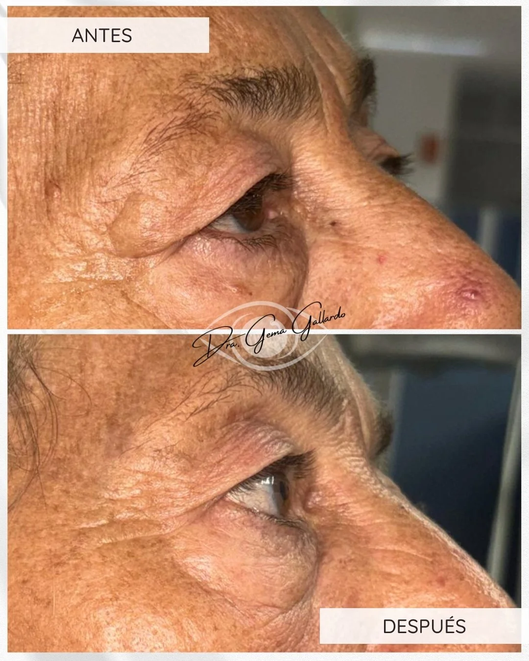 Ptosis palpebral con reaplicación de músculo elevador con blefaroplastia (3).jpg