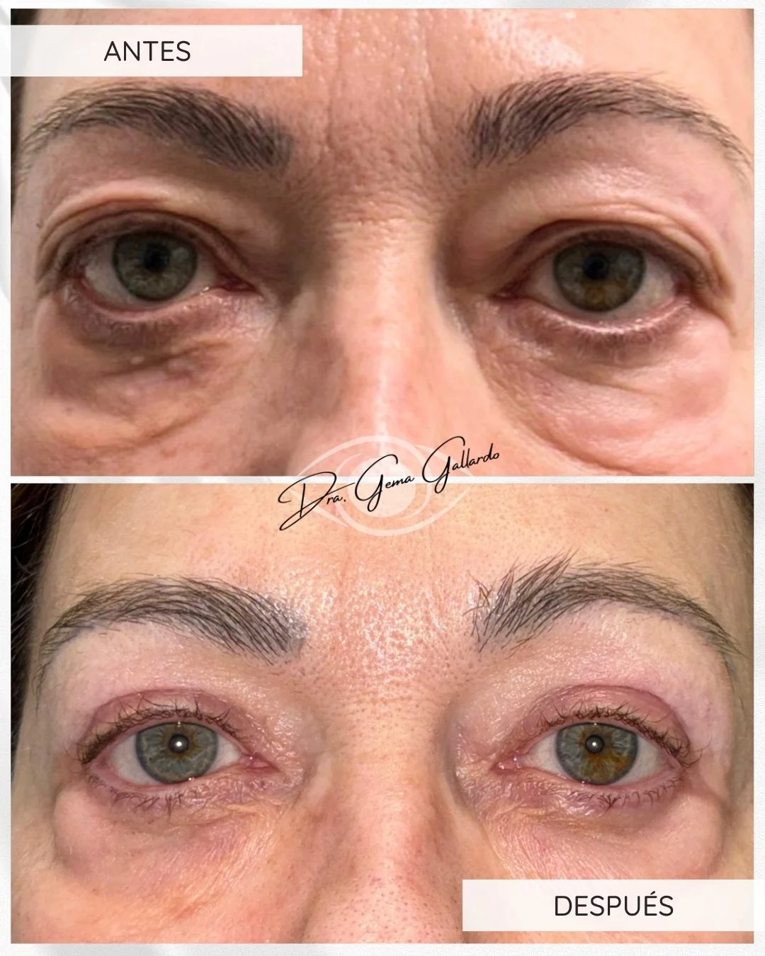 Blefaro con reposición de glándula lagrimal bilateral.jpg