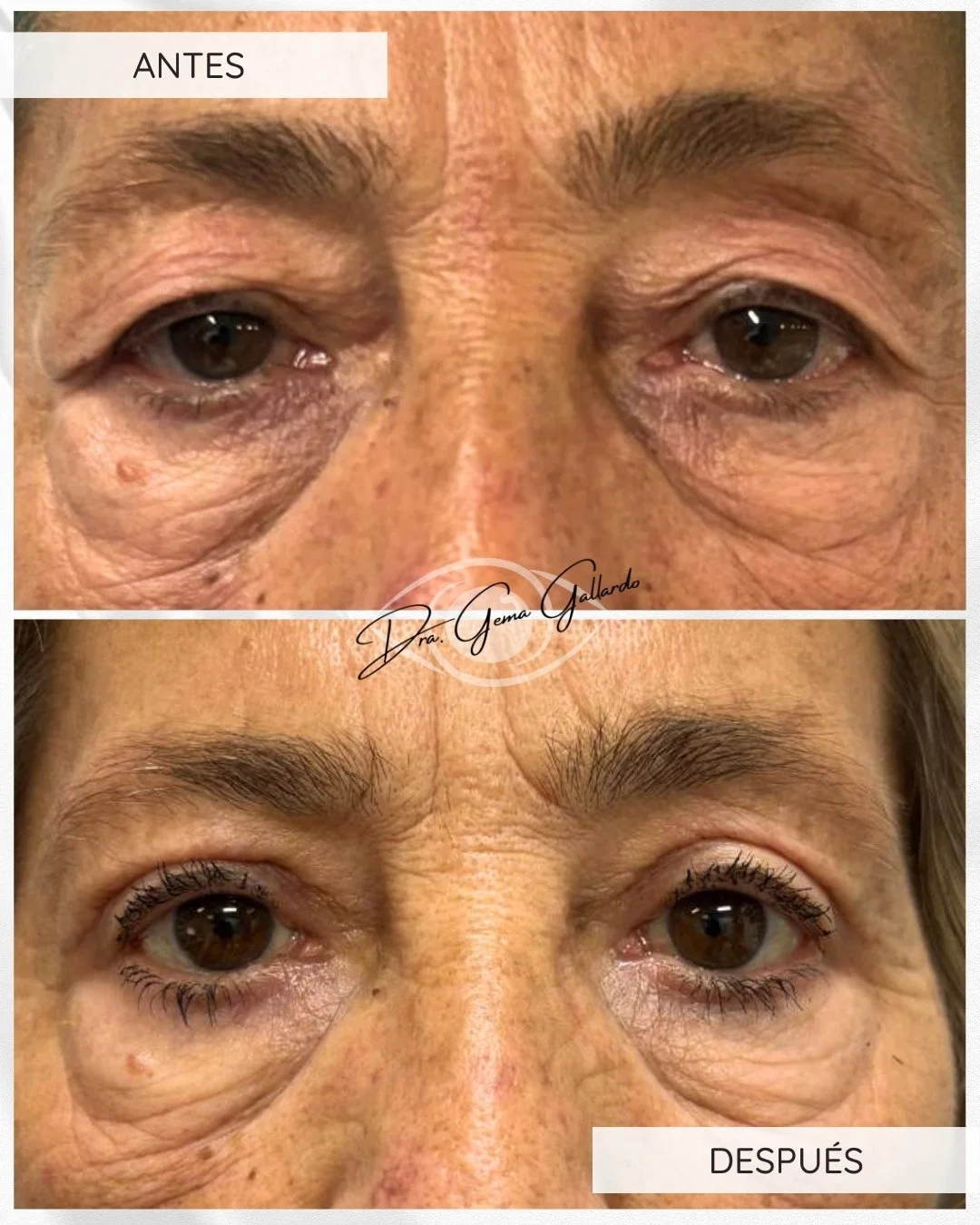 Ptosis palpebral con reaplicación de músculo elevador con blefaroplastia.jpg