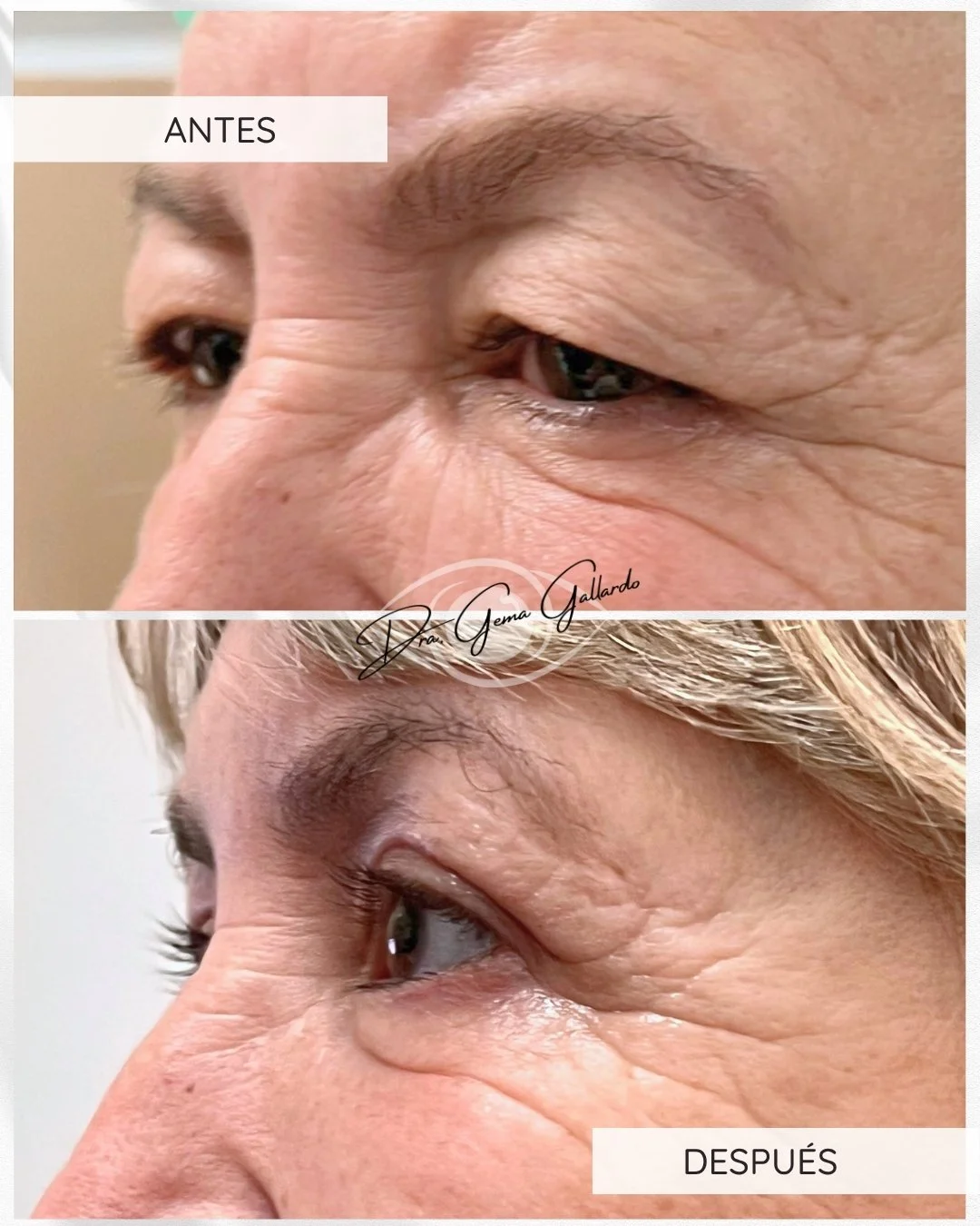 Blefaro superior con conjuntivomüllerectomía.jpg