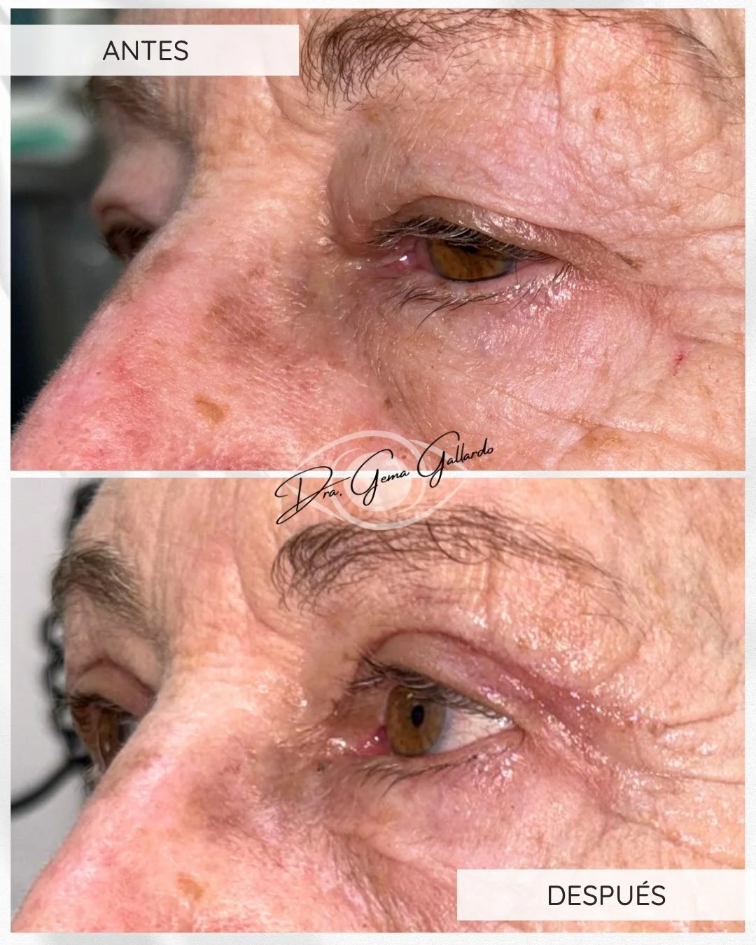 Ptosis y blefaroplastia (técnica conjuntivomüllerectomía) (3).jpg