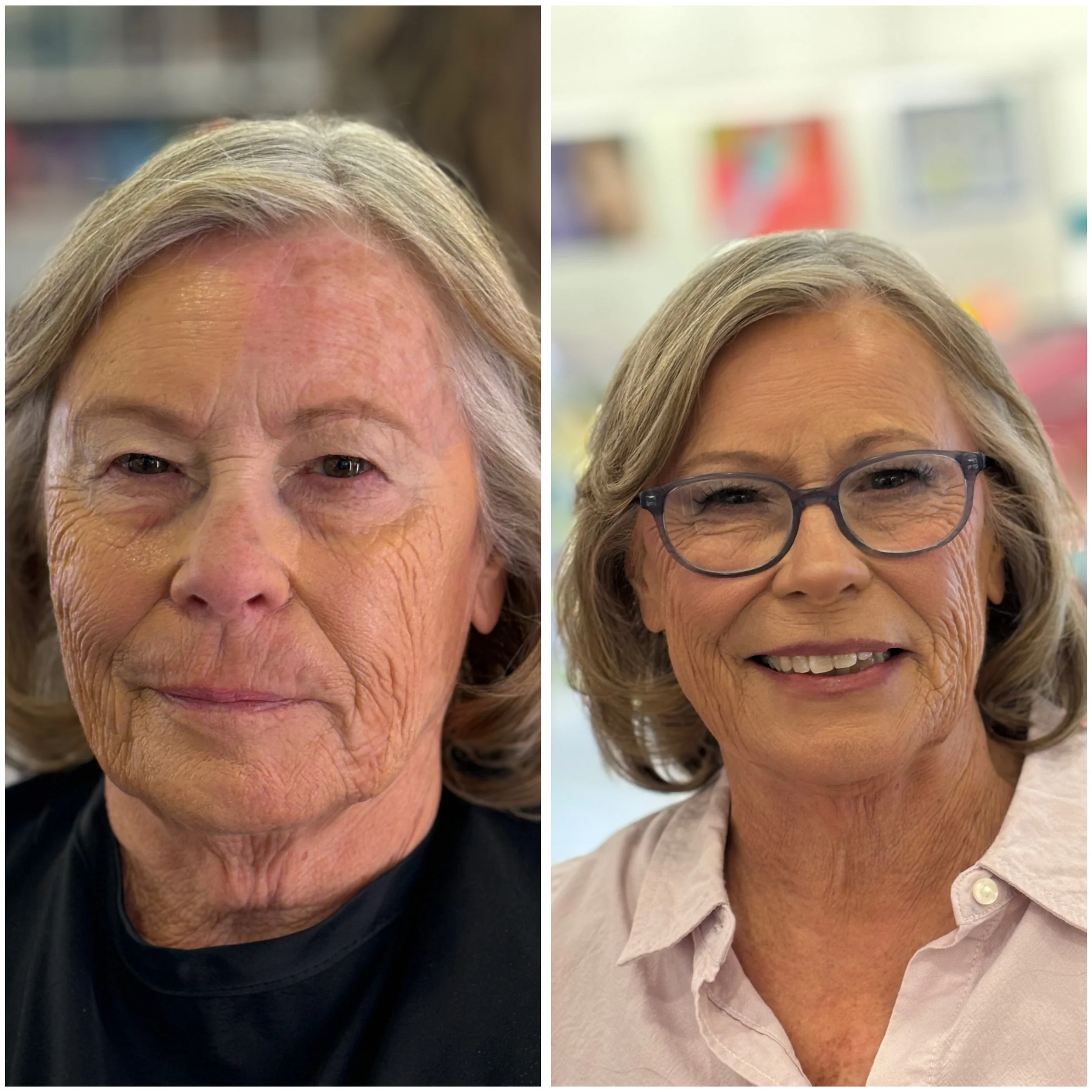 Side-by-side comparison photo of an elderly woman before and after a cosmetic treatment. The left side shows her with visibly aged skin, wrinkles, and redness. The right side shows her with smoother skin, fewer wrinkles, and a more even complexion, wearing glasses and a light-colored shirt.