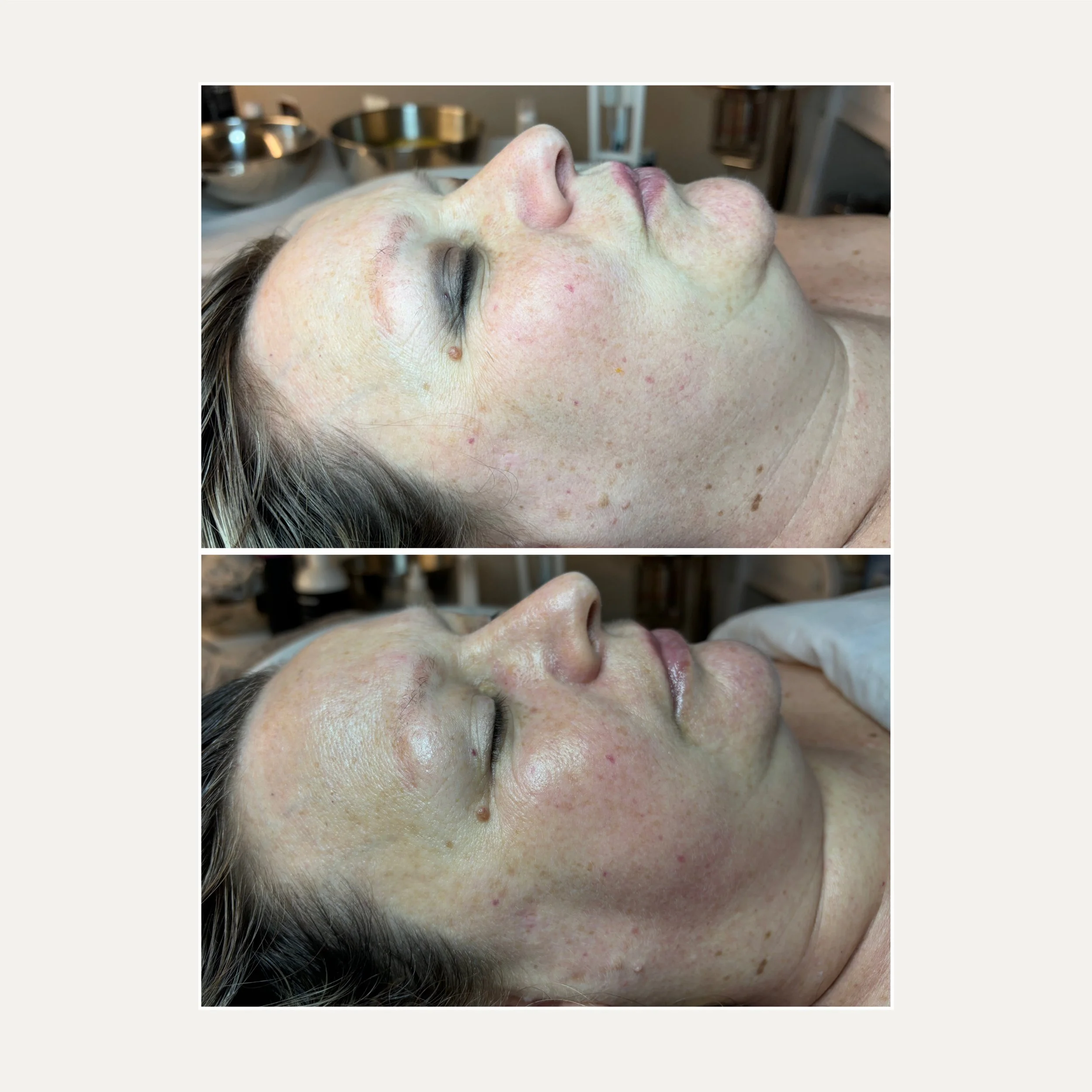 Close-up of a woman's face with closed eyes, showing skin irritation and redness, lying on a surface with medical equipment visible in the background.