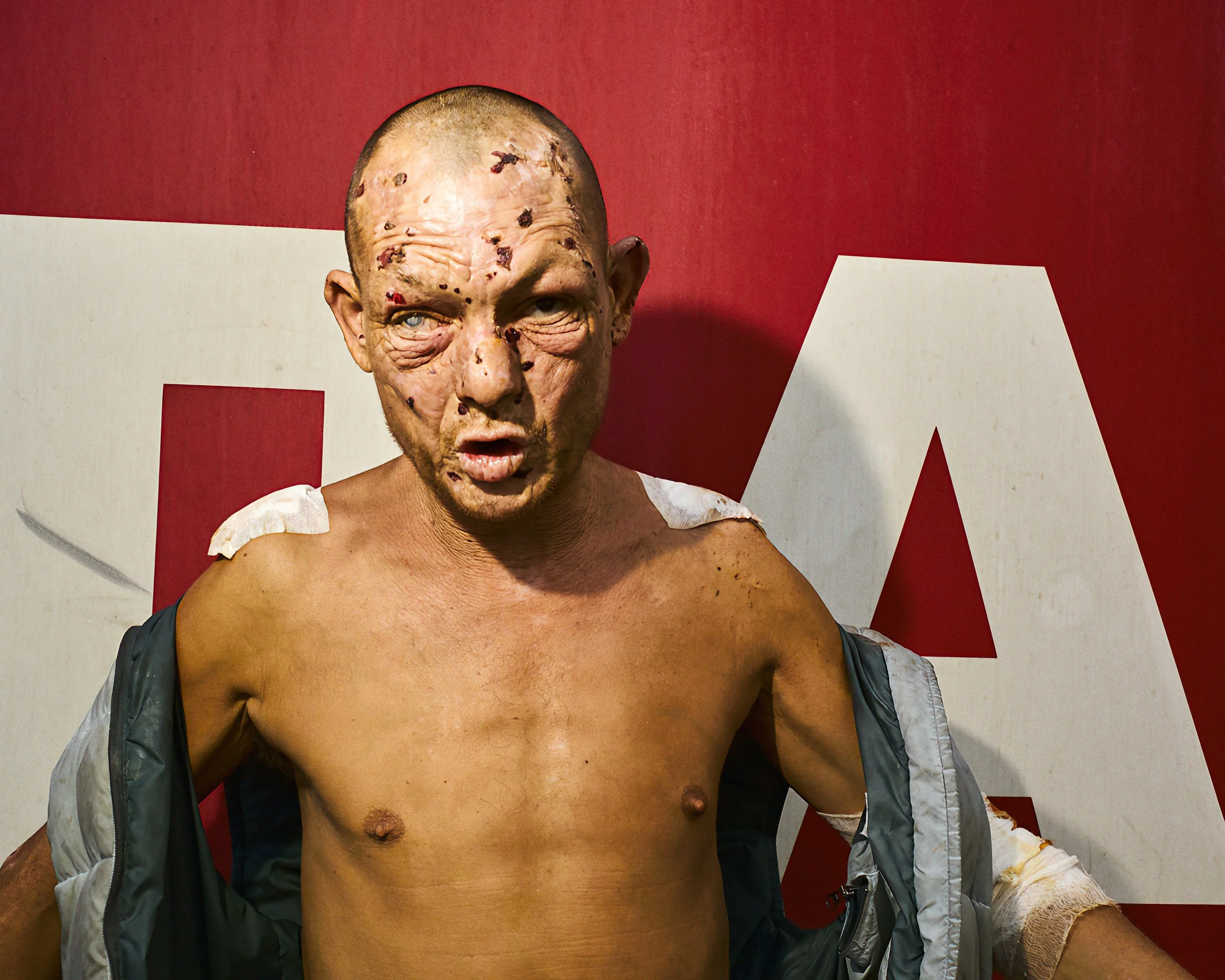A man with an injured, scarred face and a bald head standing in front of a red and white background, with his mouth open and wearing an open jacket.