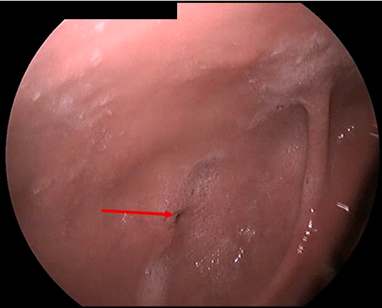 PyloricStricture.png