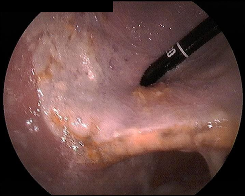 PyloricStricture2.png
