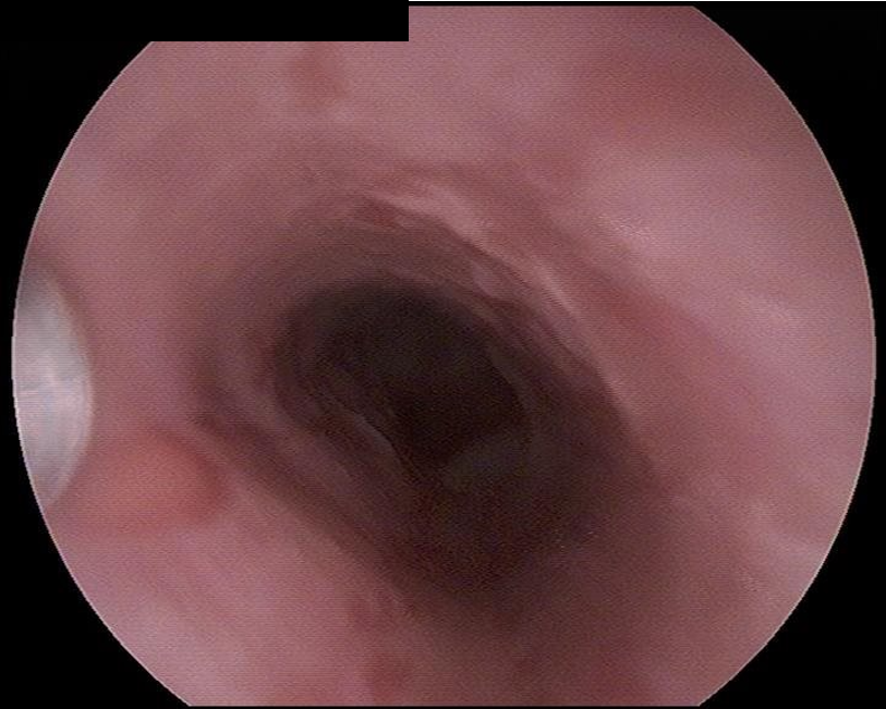 PyloricStricture3.png