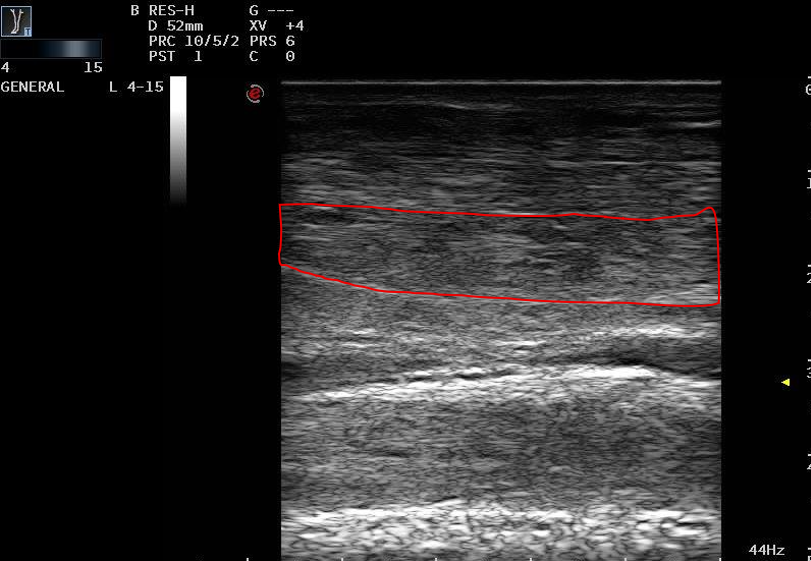 Ultrasound image showing disruption of normal fibre pattern