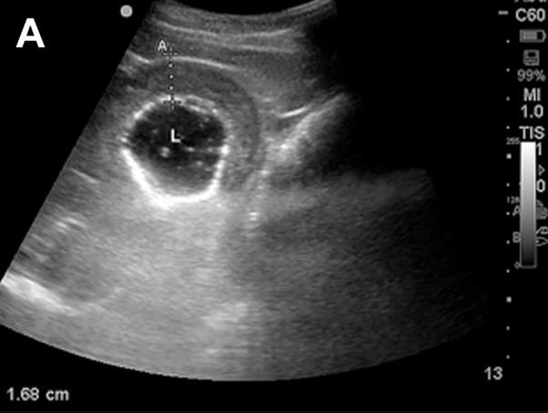 Thickened Small intestine ultrasound