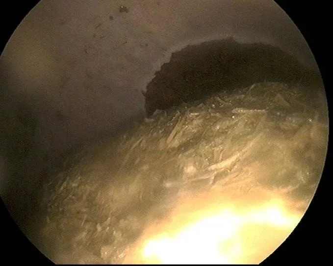 Gastroscope image showing gastric impaction