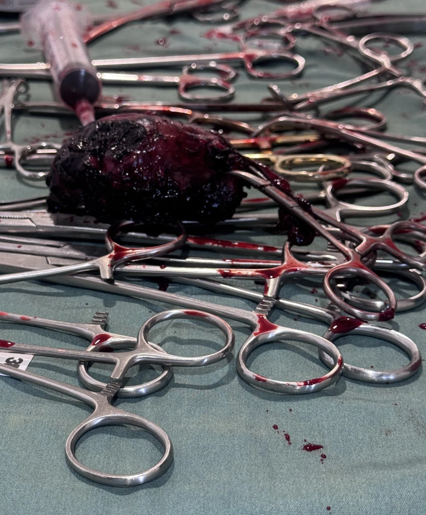 Picture of removed melanoma