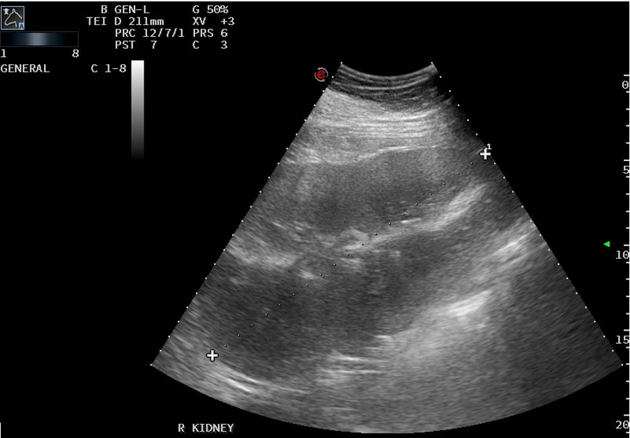 Ultrasound image of the right kidney showing enlargement.