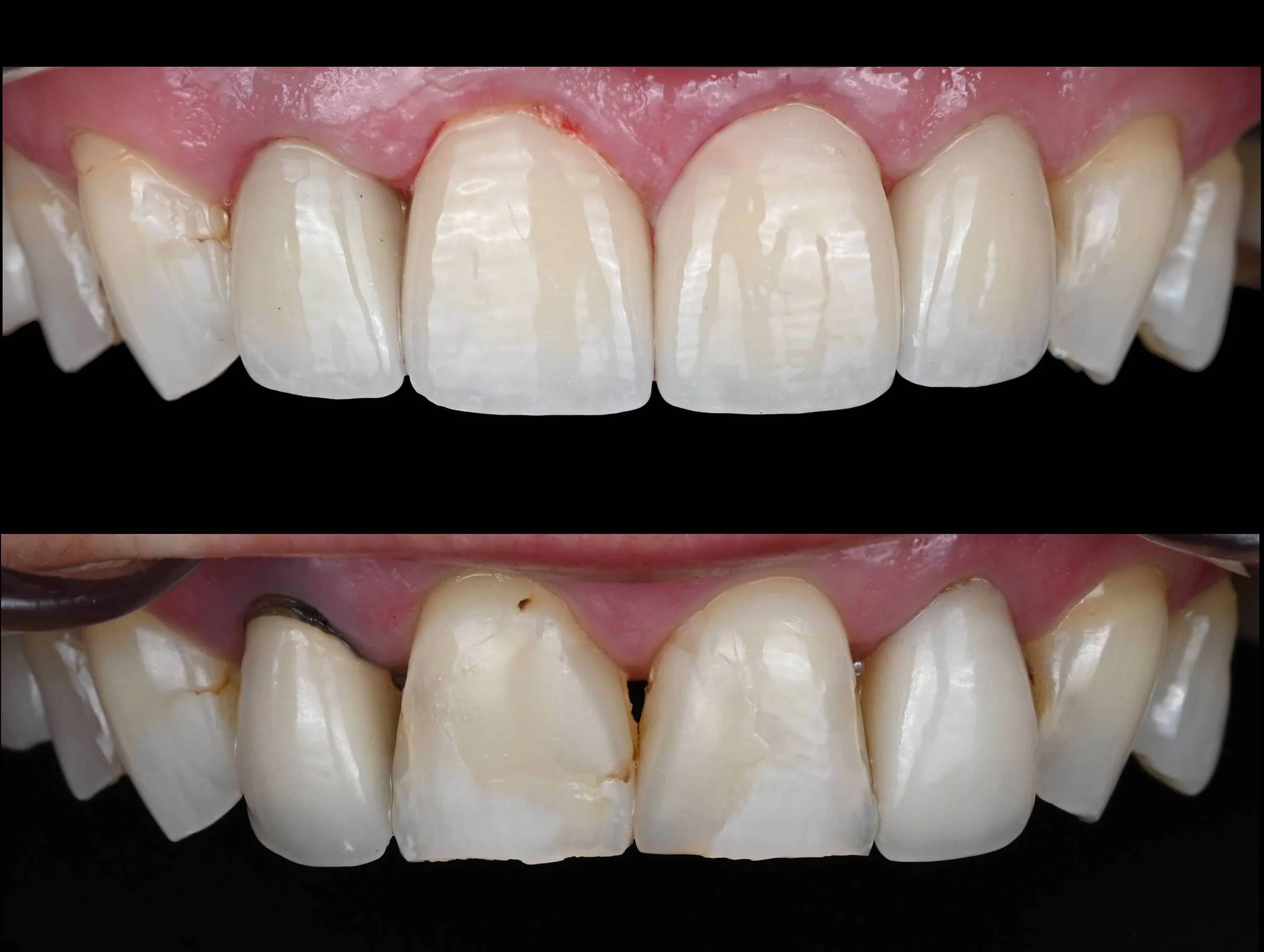 je - before and after crowns.jpg