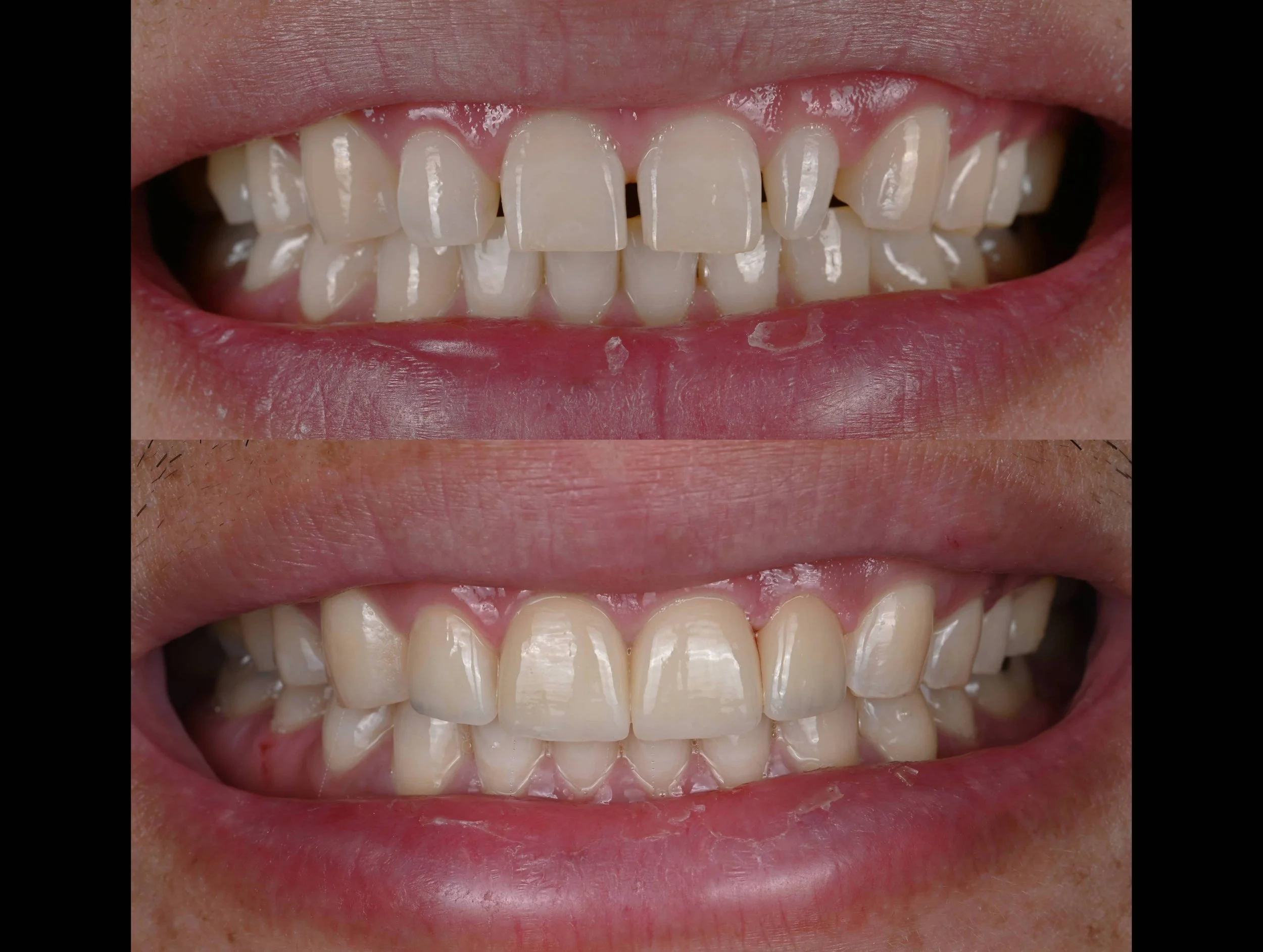 CX before and after veneers.jpg