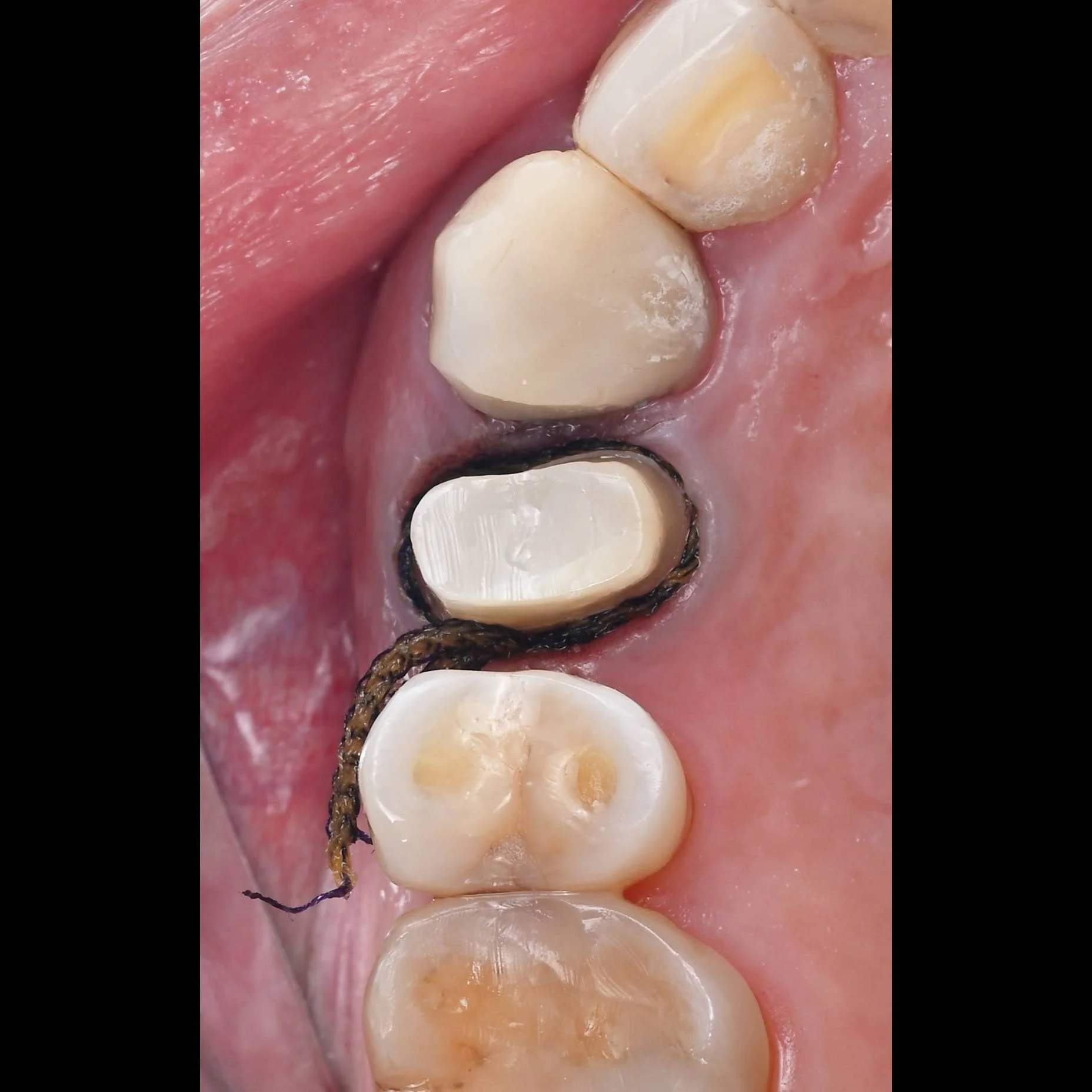 crown preparation.jpg