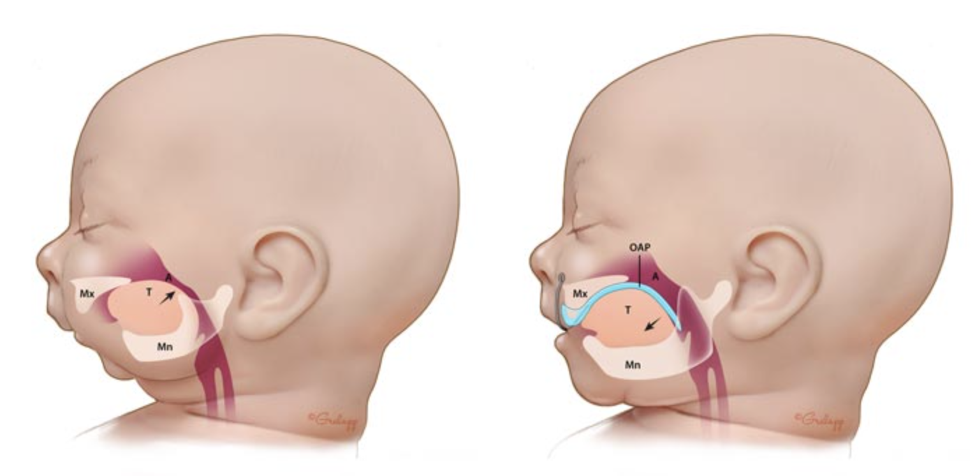 On the left, deficient skeletal growth; On the right, sufficient skeletal growth.