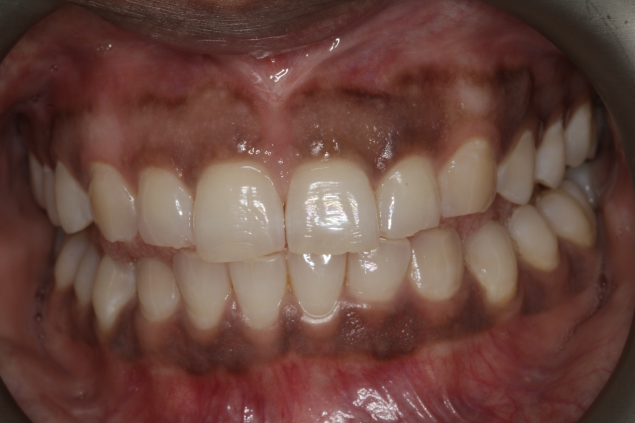 Close-up of a person's open mouth showing upper and lower teeth with some misalignment and gum redness.