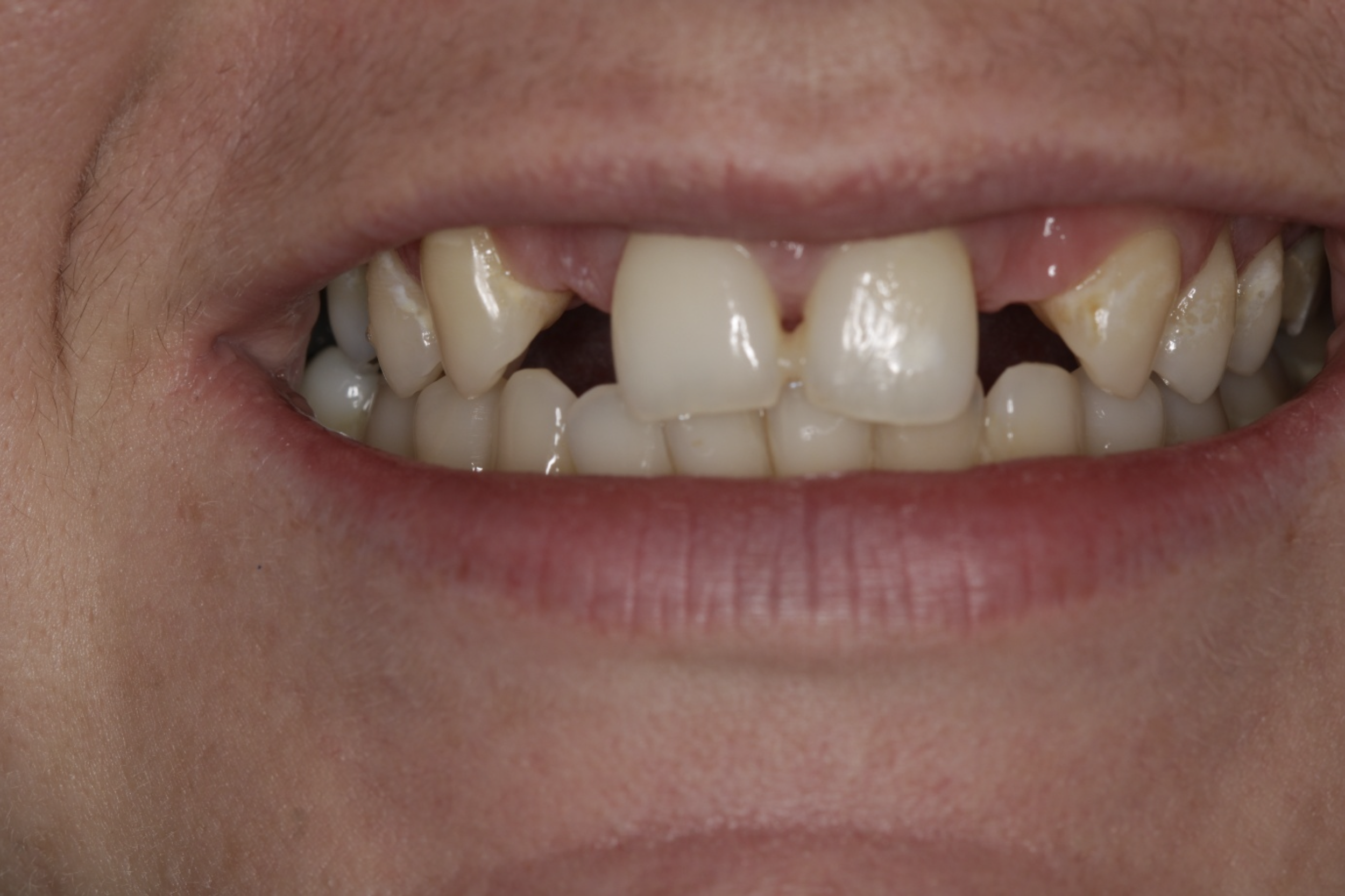 Close-up of a person's mouth with missing front teeth and decayed, crooked teeth.