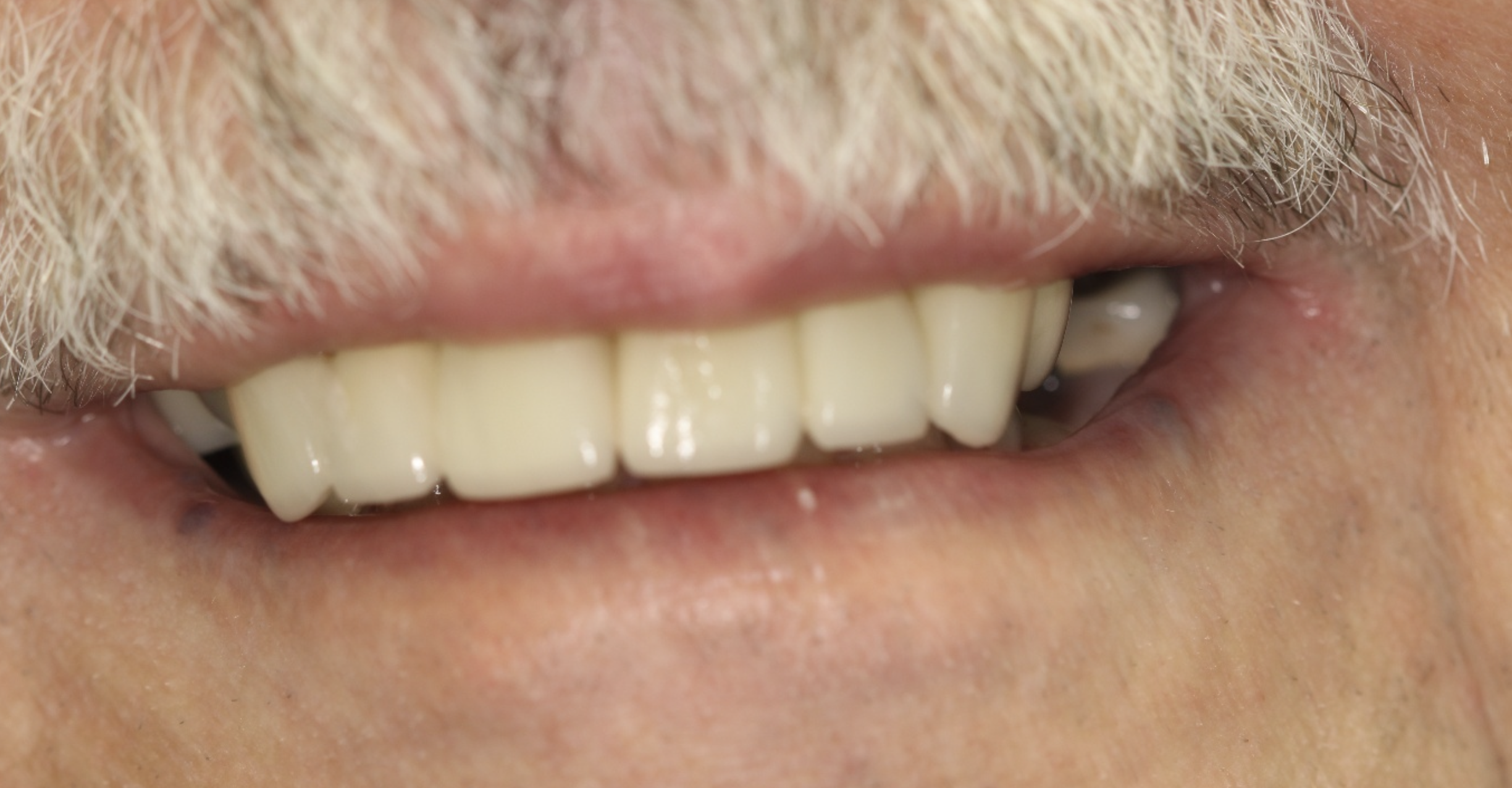 Close-up of a person's smiling mouth showing upper teeth and part of the lower teeth. The individual has facial hair and light skin.