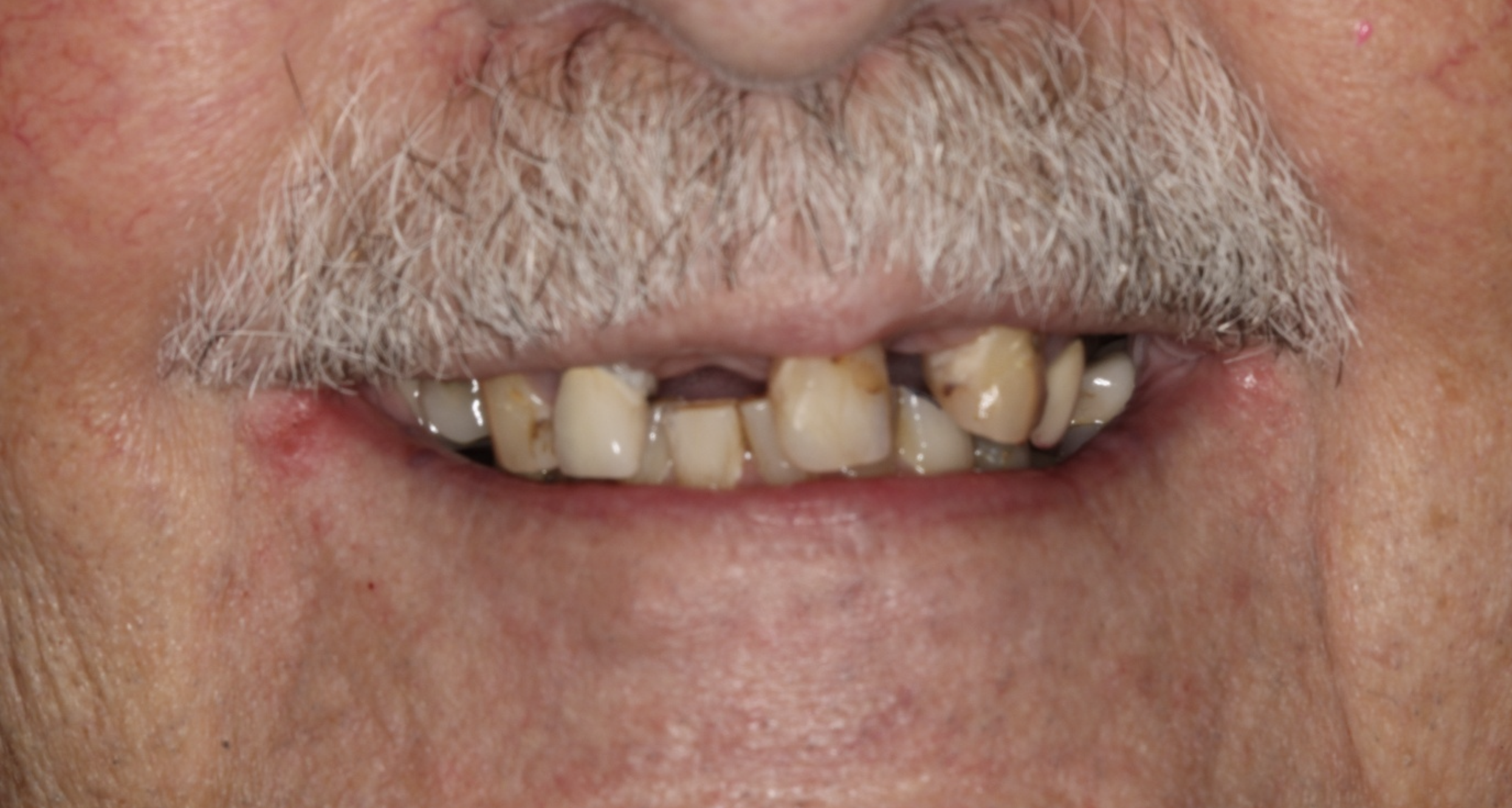 Close-up of an elderly person's mouth showing severely decayed, discolored, and broken teeth.