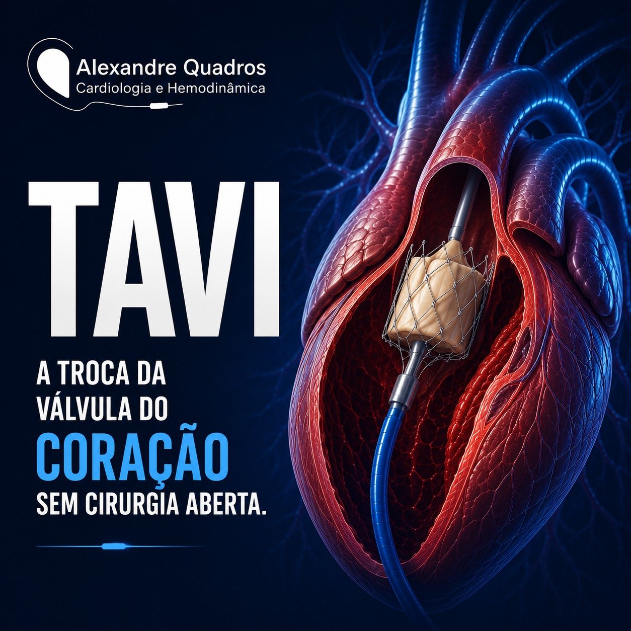 TAVI: A troca da válvula do coração sem cirurgia aberta

