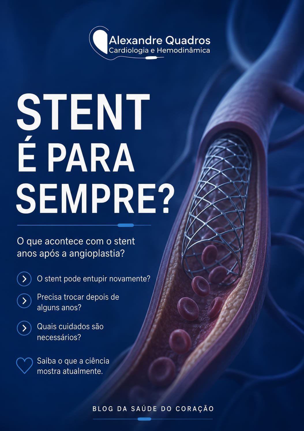 Stent para sempre? O que acontece com o stent anos após a angioplastia