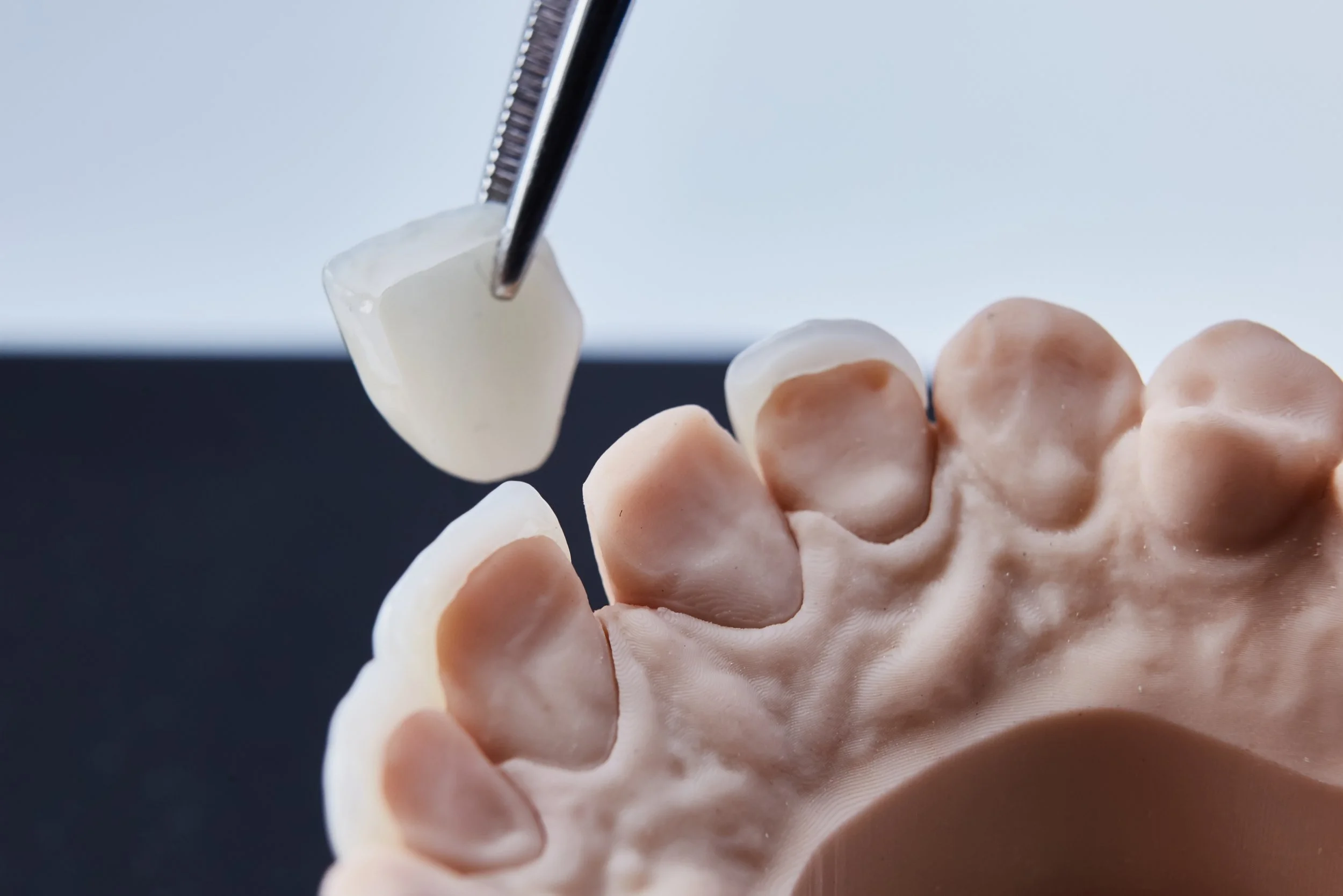 Veneers für Frontzähne: Wann sie sinnvoll sind und für wen sie geeignet sind.