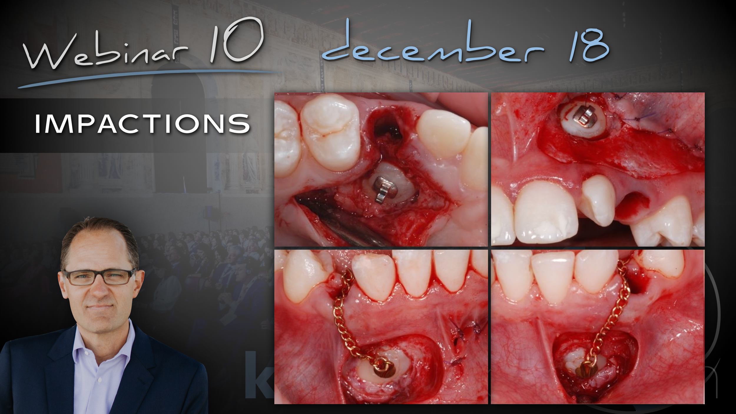 Impactions - Maxillary Canines