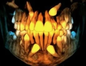 How to Properly Manage Patients with Impacted Canines - December 10th