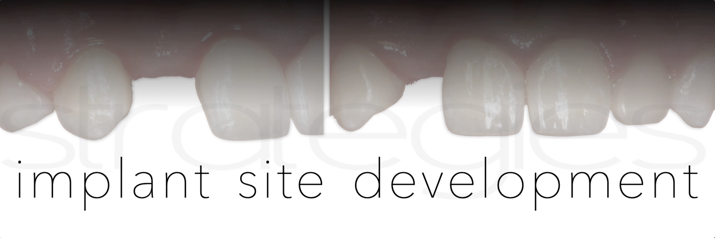 Missing Laterals - Implant Site Development