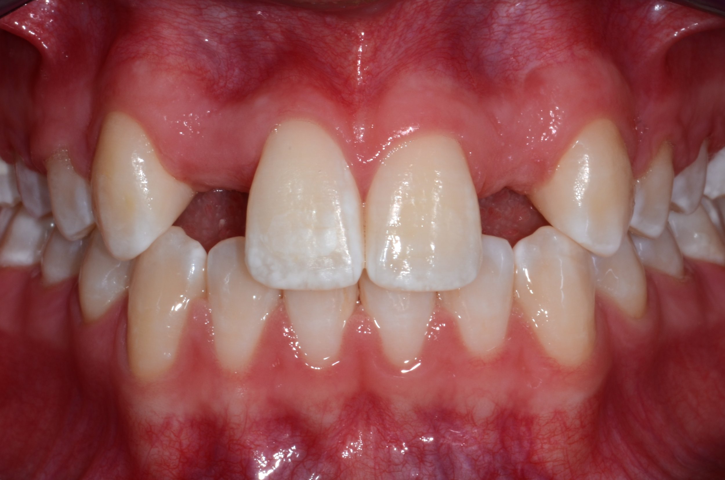 Missing Lateral Incisors - Should I Open the Space? - November 19th