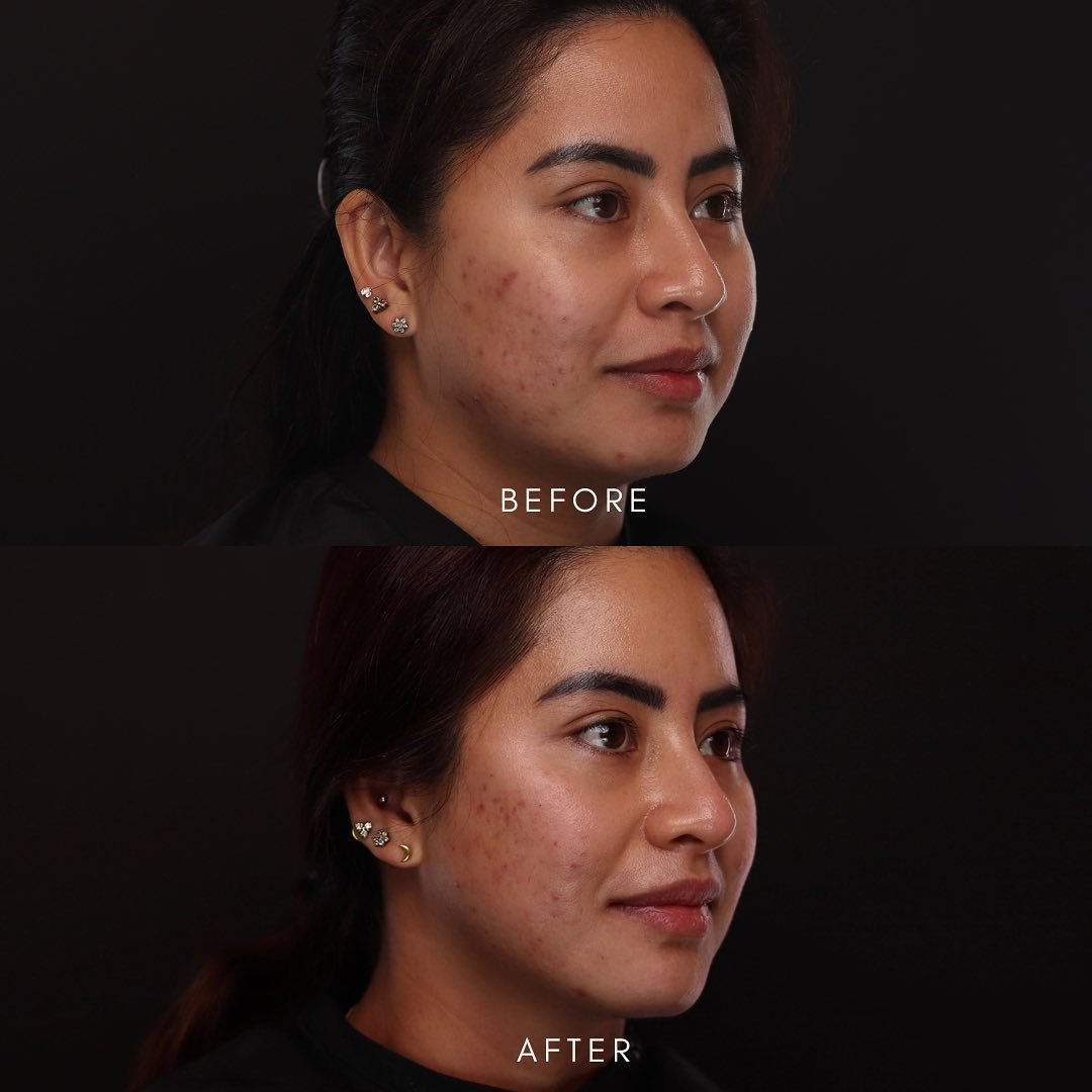 ✨ 5-Point Lift ✨ for facial rejuvenation &amp; definition ✨

💉 Dermal Filler Treatment @thevanitylab 

#injectables #filler #botox #cosmeticinjector
