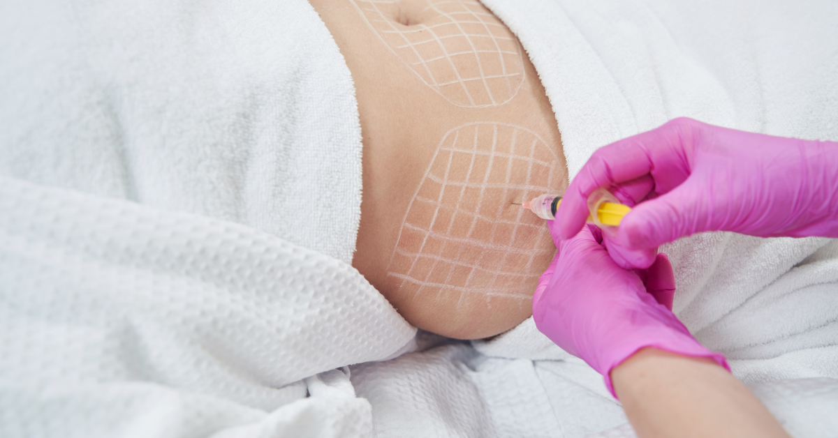 A person lying down receiving an injection in their abdomen, with white grid markings for cosmetic treatment or procedure, while wearing pink gloves.