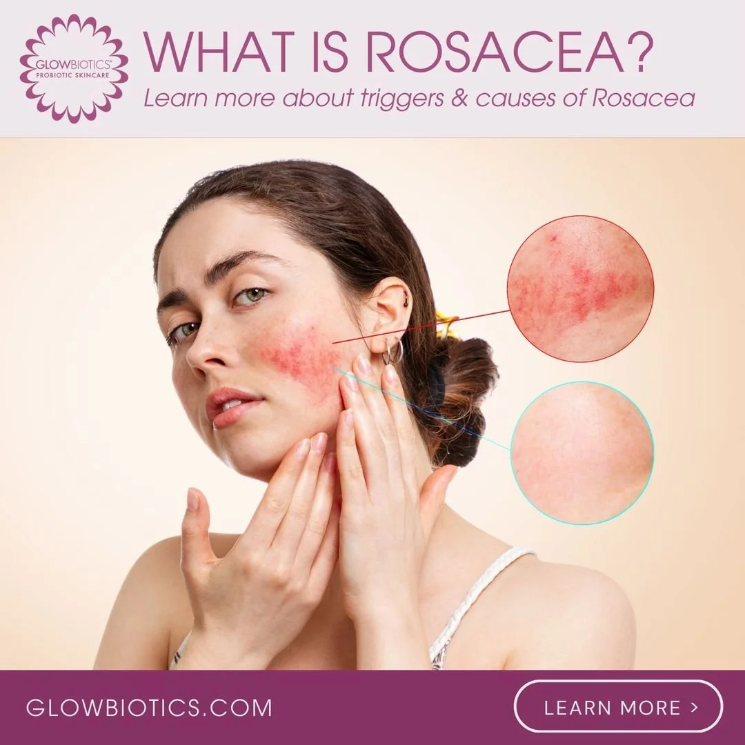 04-02-2024-what-is-rosacea-slide 1.jpg