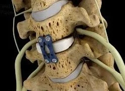 Anterior Cervical Disectomy and Fusion