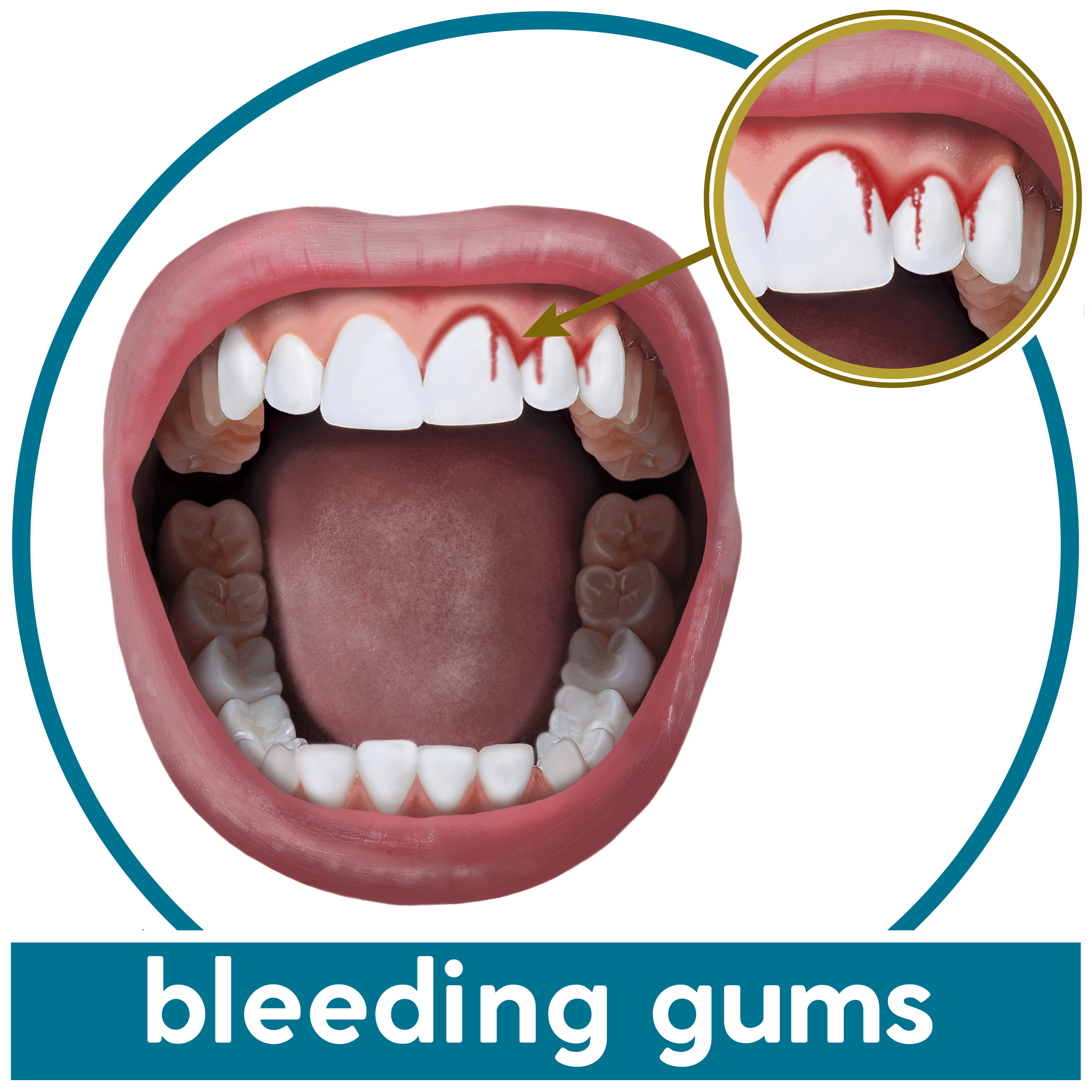 bleeding gums.png