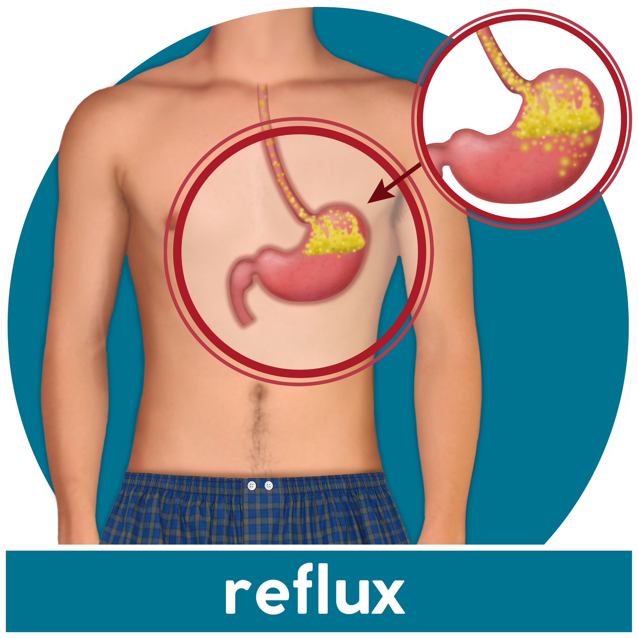 Male reflux disease.png