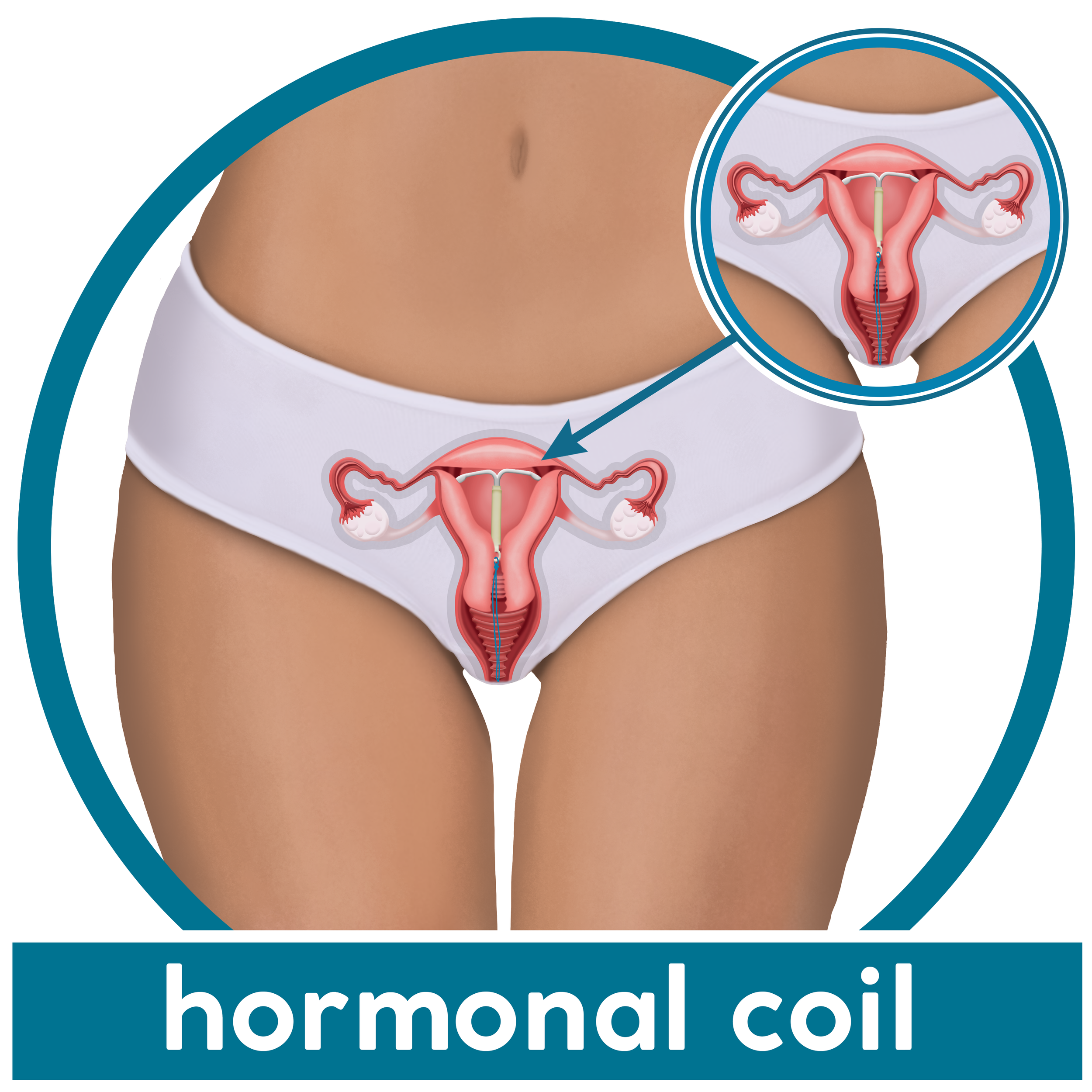 hormonal coil 2.png