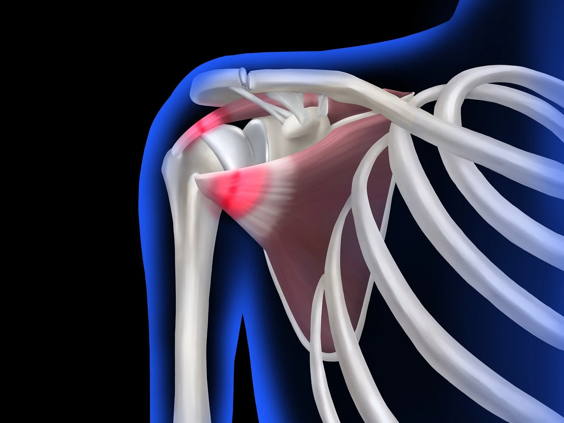 Rotator Cuff Tears &amp; Surgery