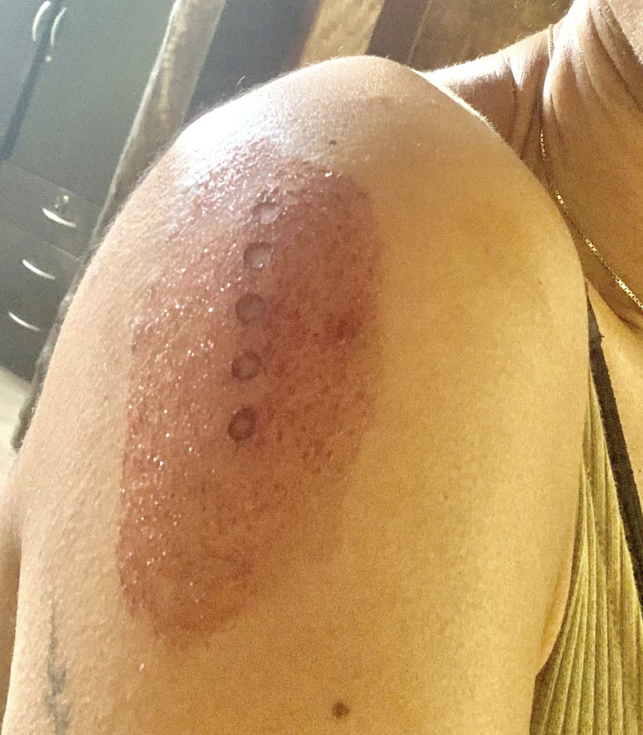 A person's shoulder with a red, circular, raised skin rash or wound.