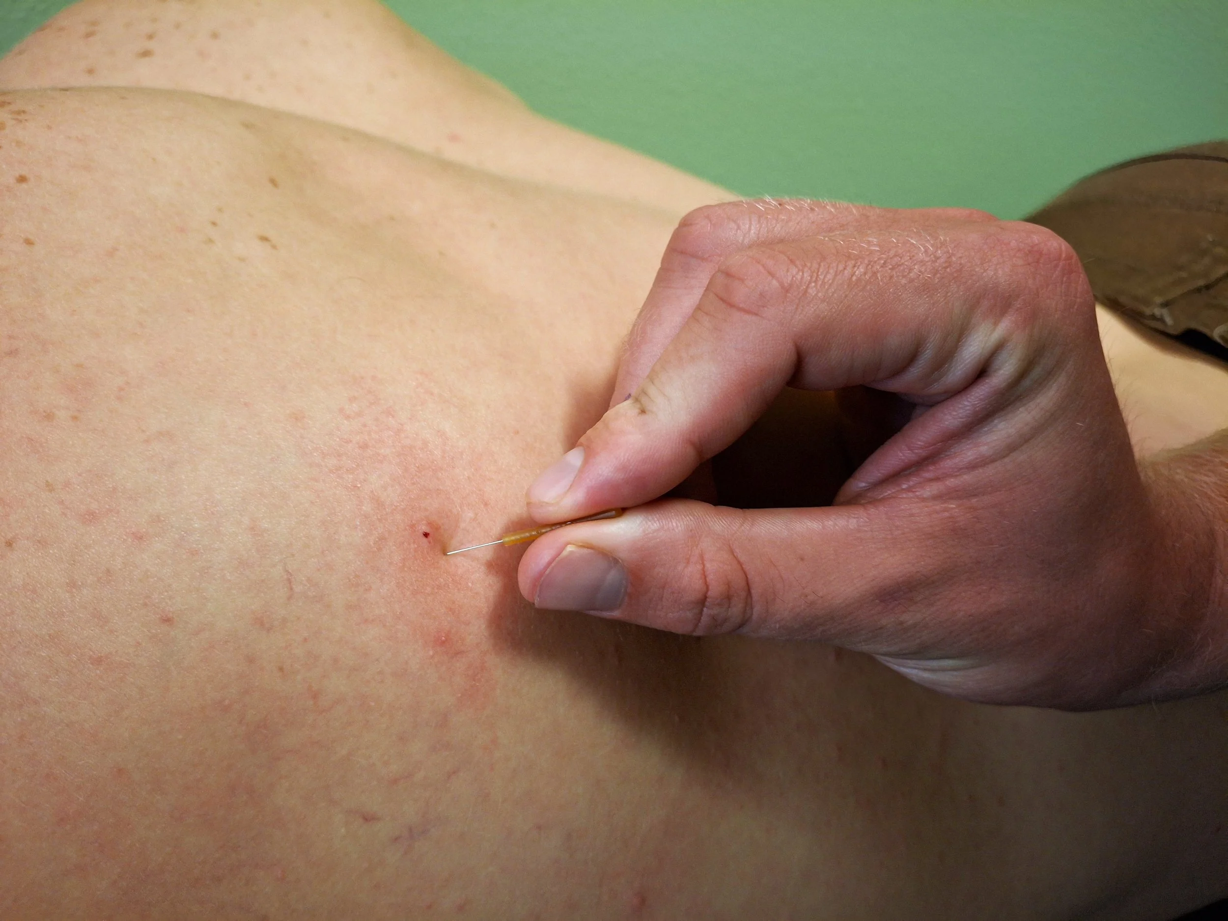 "A close-up of a therapist performing dry needling on a patient's shoulder, inserting a thin needle into a trigger point."