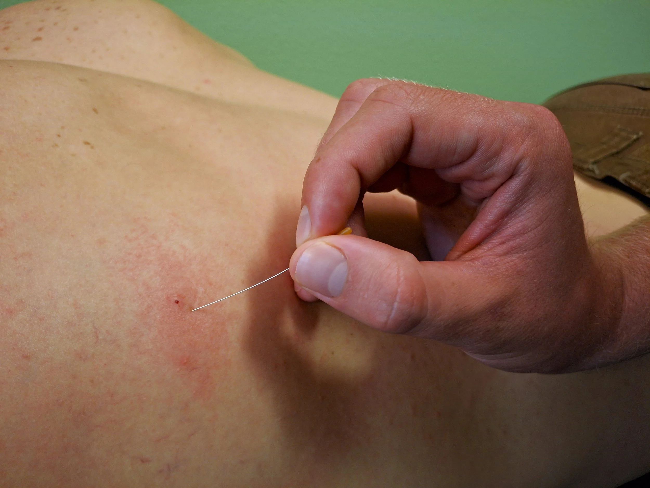 Dry Needling